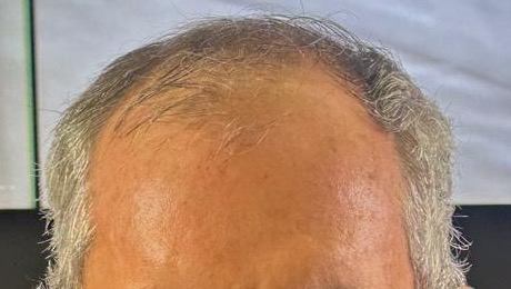 Couro cabeludo com rarefação acentuada no topo, antes do tratamento