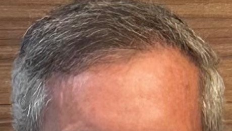 Couro cabeludo com maior cobertura capilar, depois do tratamento